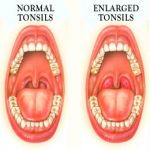 What Causes Large Tonsils in Kids and How to Treat?