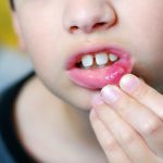 Mouth Ulcers in Children
