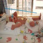 Premature Baby Born at 34th Week of Pregnancy