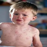 Fever and Rash in Toddlers