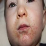 What Causes Rashes Around Your Toddlers' Mouth?