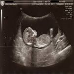 When Can You See a Baby on Ultrasound?