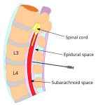 Difference Between Epidural And Spinal Block