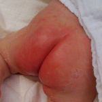 How to Treat and Prevent Really Bad Diaper Rash