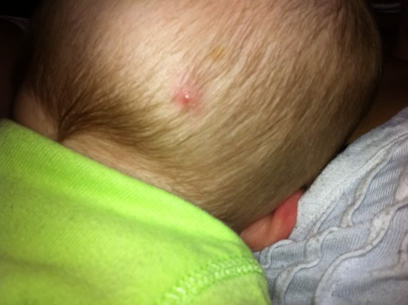 Pimple On Baby S Head New Kids Center