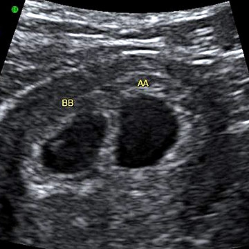 6 Week Ultrasound Twins' Pictures.